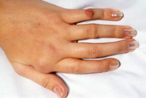 interfalangealna artroza liječenja ruku)
