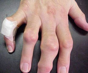 simetrična bol u zglobovima prstiju