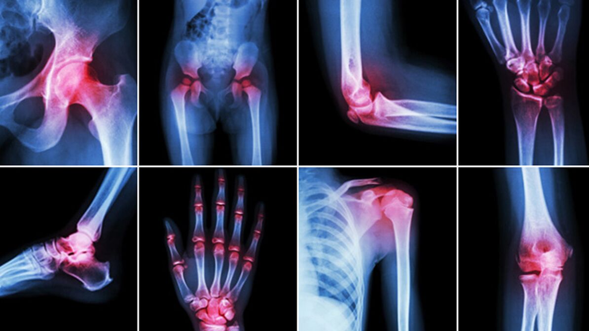 bol u mišićima i zglobovima ujutro artroza uzrokuje simptome i liječenje