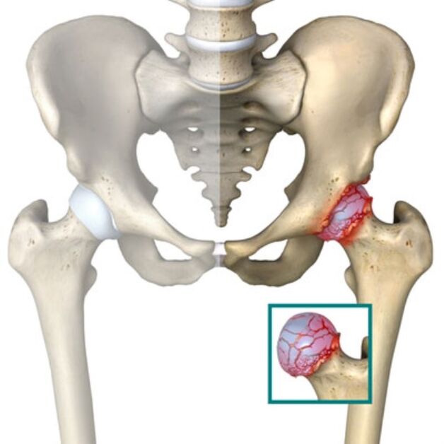 osteochondrosis liječenje osteoartritisa)