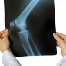 bol osteoartritisa koljena