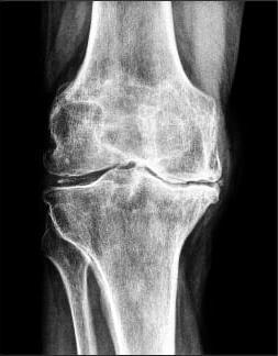 mjesec dana nakon artroplastike koljena