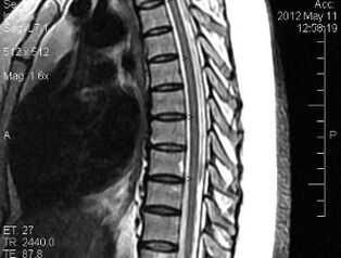 MRI torakalne kičme