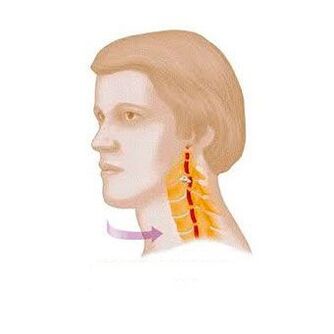 vertebralni sindrom sa cervikalnom osteohondrozo