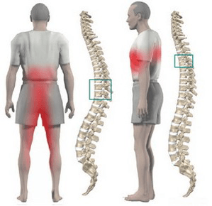 bol u leđima kod torakalne osteohondroze