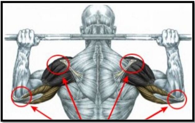 Opterećenje mišića ramena i lakta jedan je od uzroka artroze ramenog zgloba