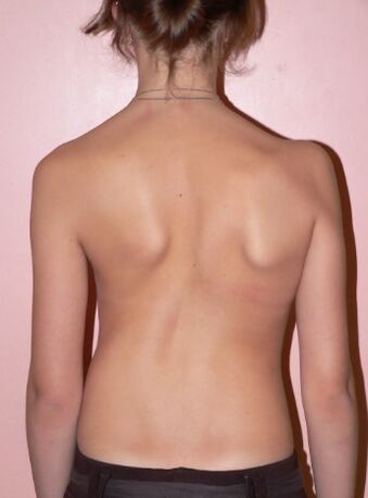 Scoliosis 2 stepena