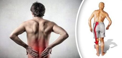 Sindrom boli sa lumbalnom osteohondrozom zrače na noge