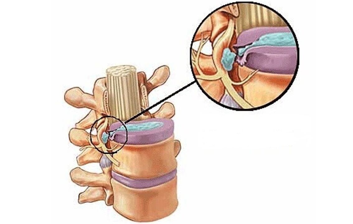 intervertebralna kila s torakalnom osteohondrozo